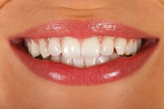Featured image for “Does Tooth Bonding Look Natural?”